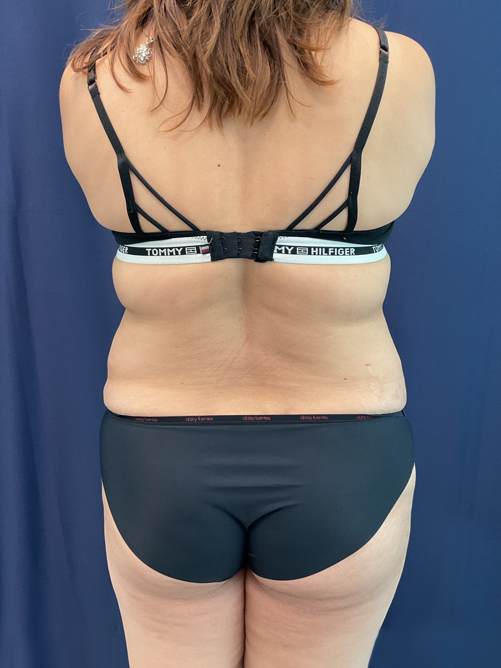 Abdominoplasty Patient Photo - Case 4922 - before view-4