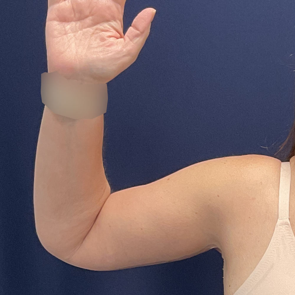 Arm Lift Patient Photo - Case 5006 - after view