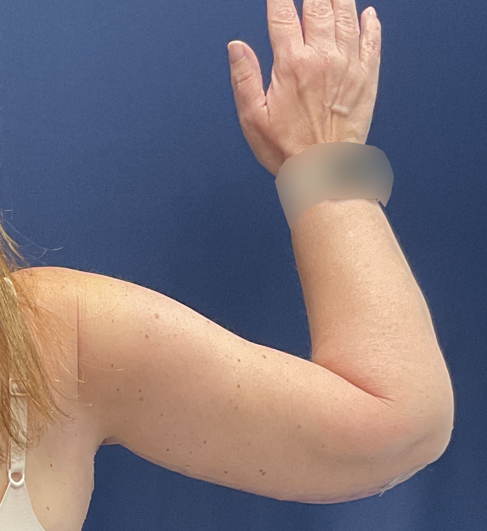 Arm Lift Patient Photo - Case 5006 - after view-3