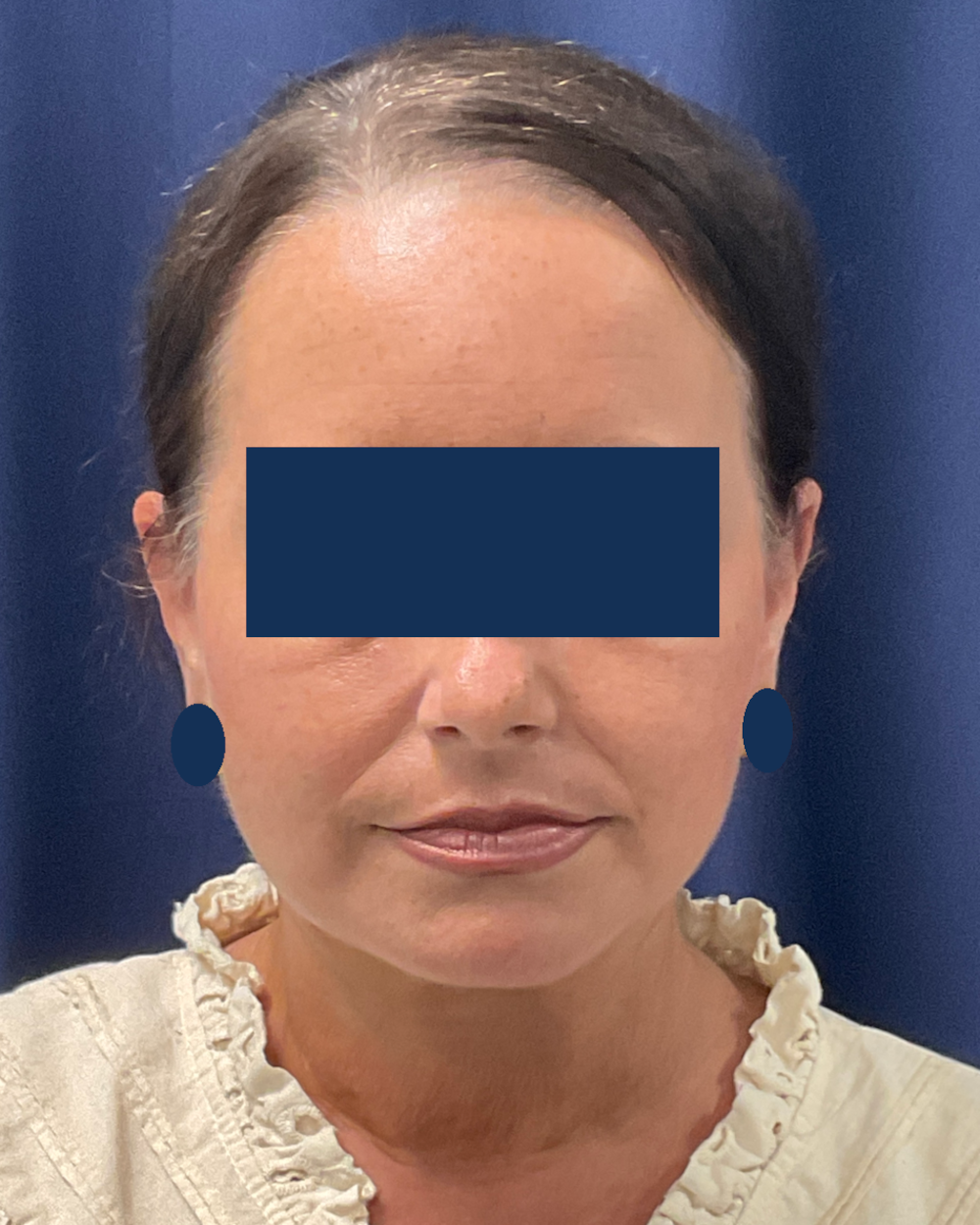 Necklift/Facelift Patient Photo - Case 5100 - after view