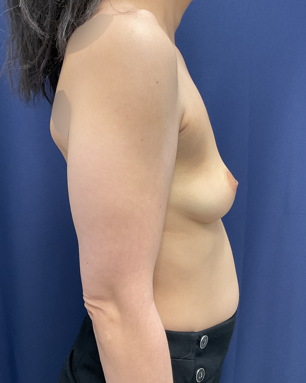 Breast Augmentation Patient Photo - Case 5112 - before view-4