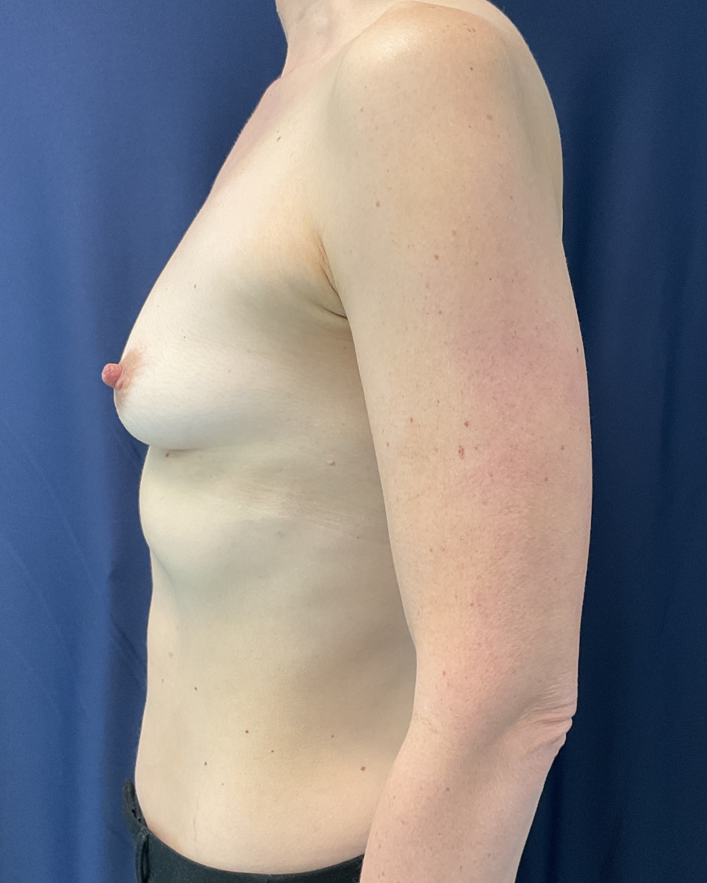 Breast Augmentation Patient Photo - Case 5124 - before view-2