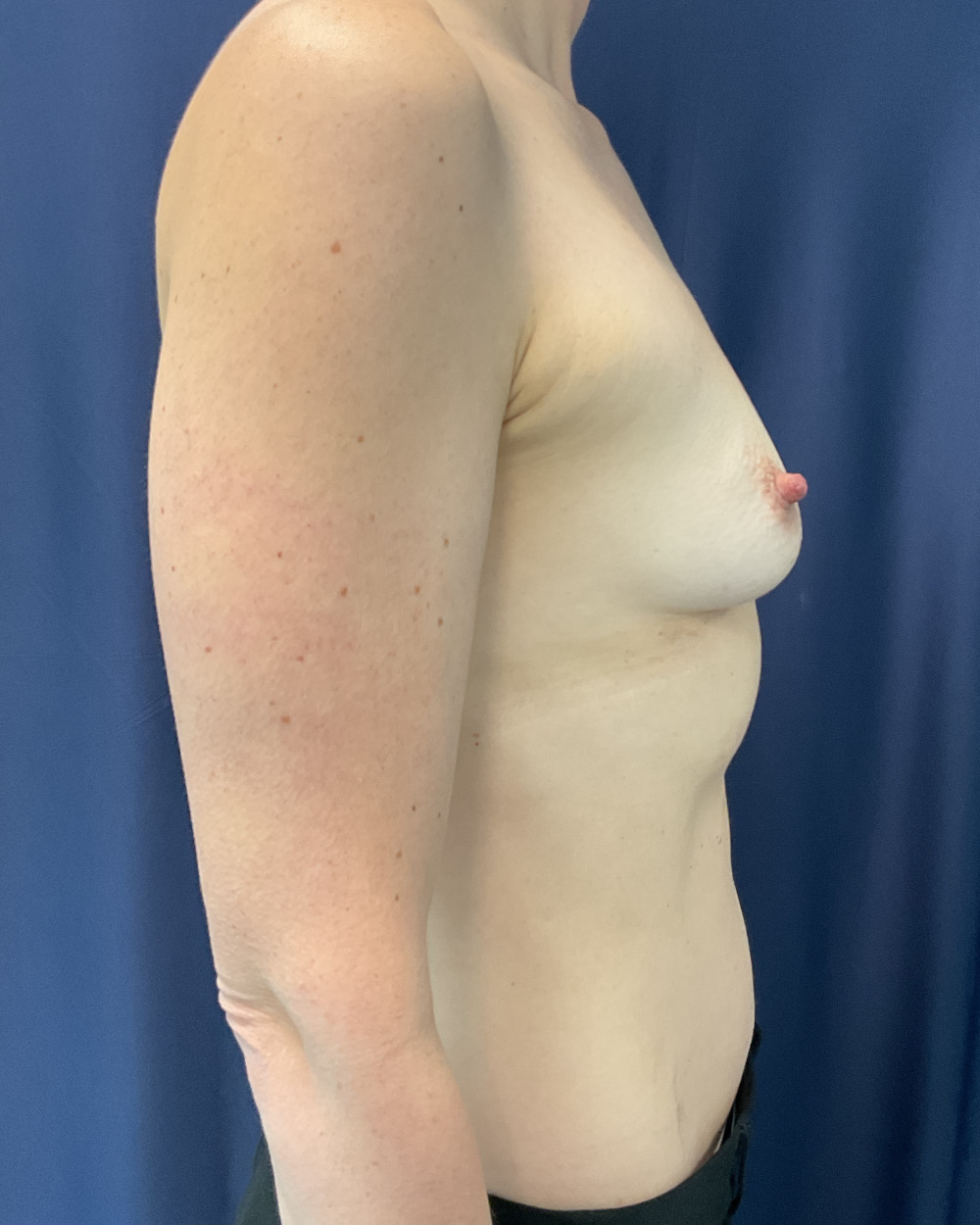 Breast Augmentation Patient Photo - Case 5124 - before view-4
