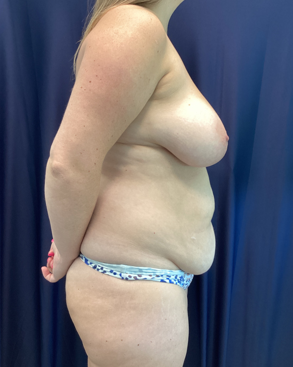 Abdominoplasty Patient Photo - Case 5149 - before view-4
