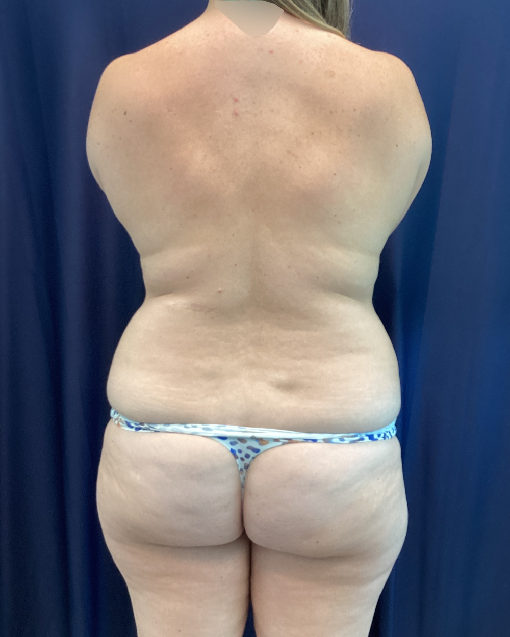 Abdominoplasty Patient Photo - Case 5149 - before view-5