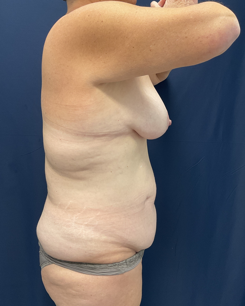 Abdominoplasty Patient Photo - Case 5174 - before view-5