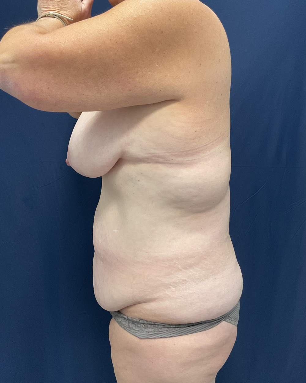 Abdominoplasty Patient Photo - Case 5174 - before view-3