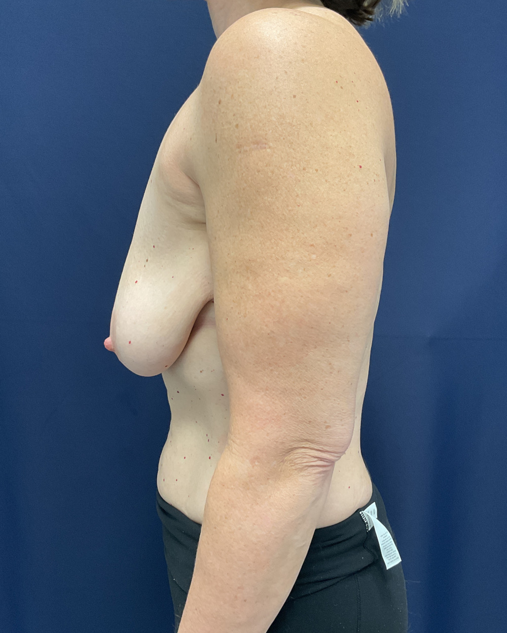 Breast Lift Patient Photo - Case 5188 - before view-2