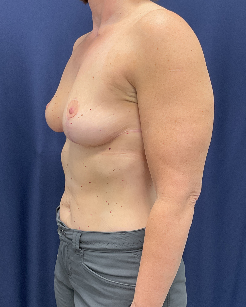 Breast Lift Patient Photo - Case 5188 - after view-1