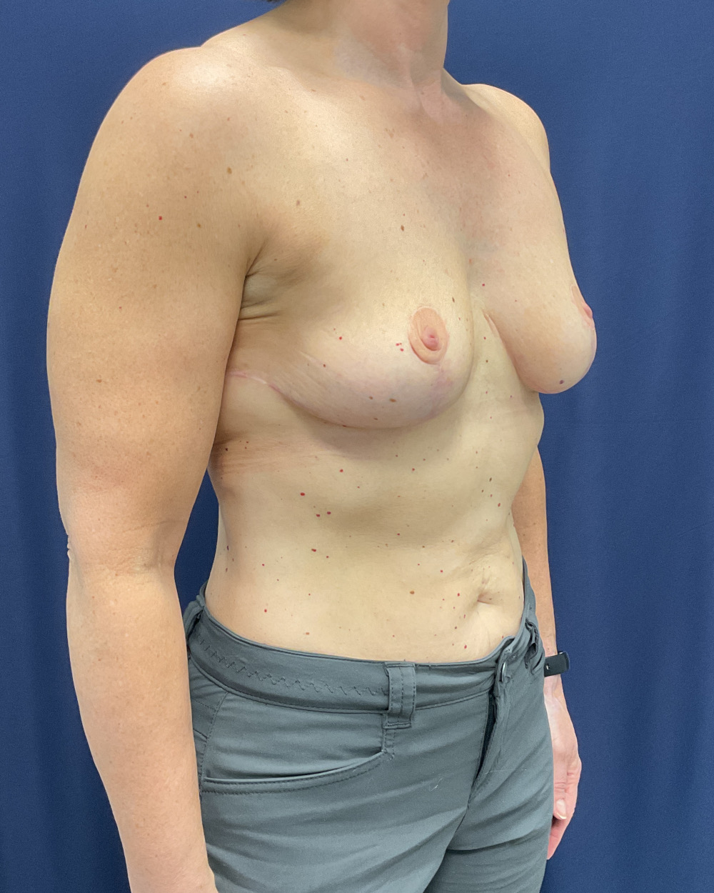 Breast Lift Patient Photo - Case 5188 - after view-3