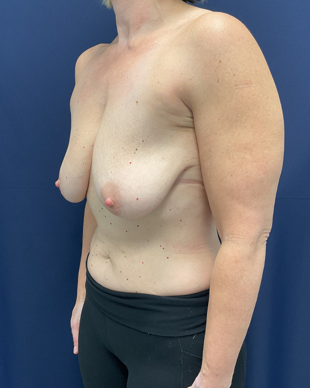 Breast Lift Patient Photo - Case 5188 - before view-1