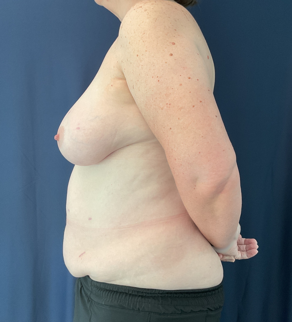 Breast Reconstruction Patient Photo - Case 5266 - before view-2