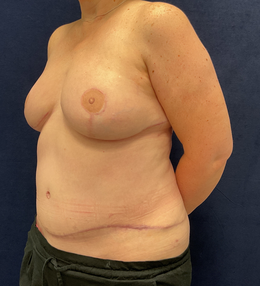 Breast Reconstruction Patient Photo - Case 5266 - after view-1