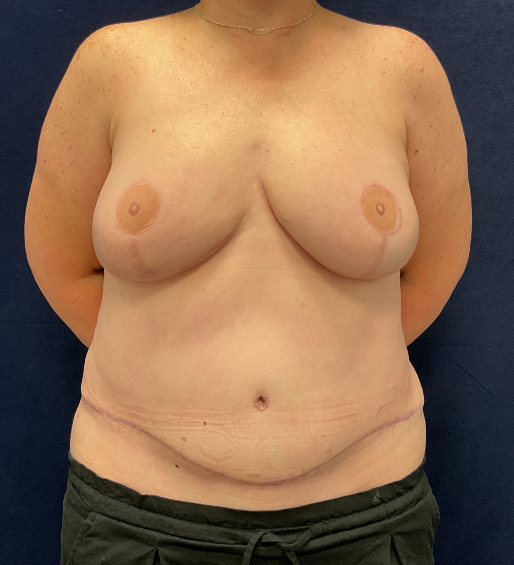 Breast Reconstruction Patient Photo - Case 5266 - after view