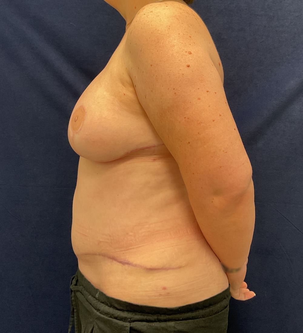 Breast Reconstruction Patient Photo - Case 5266 - after view-2