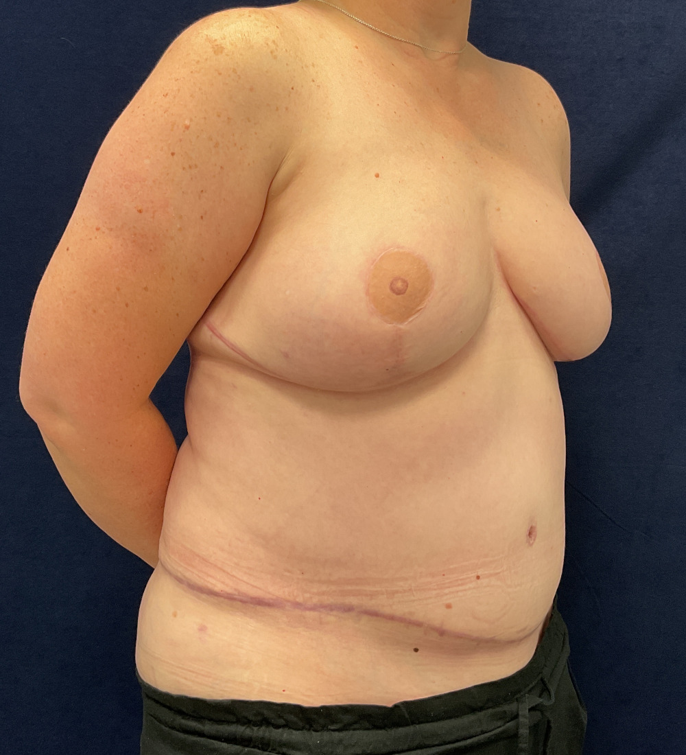 Breast Reconstruction Patient Photo - Case 5266 - after view-3