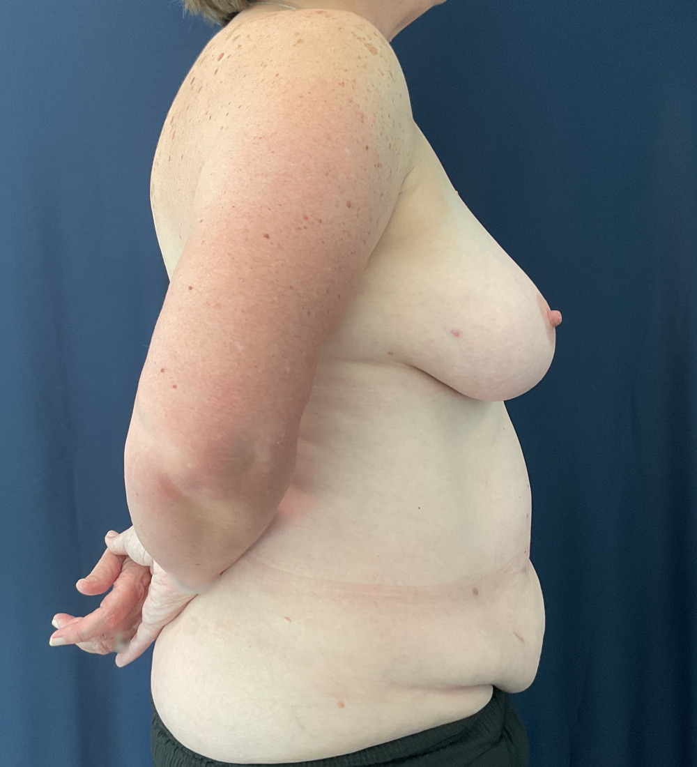 Breast Reconstruction Patient Photo - Case 5266 - before view-4