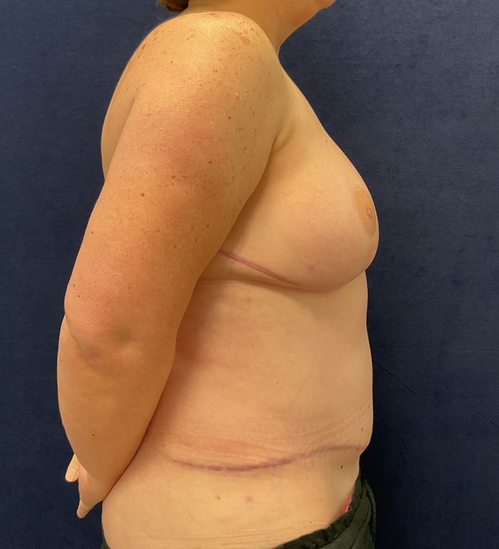 Breast Reconstruction Patient Photo - Case 5266 - after view-4