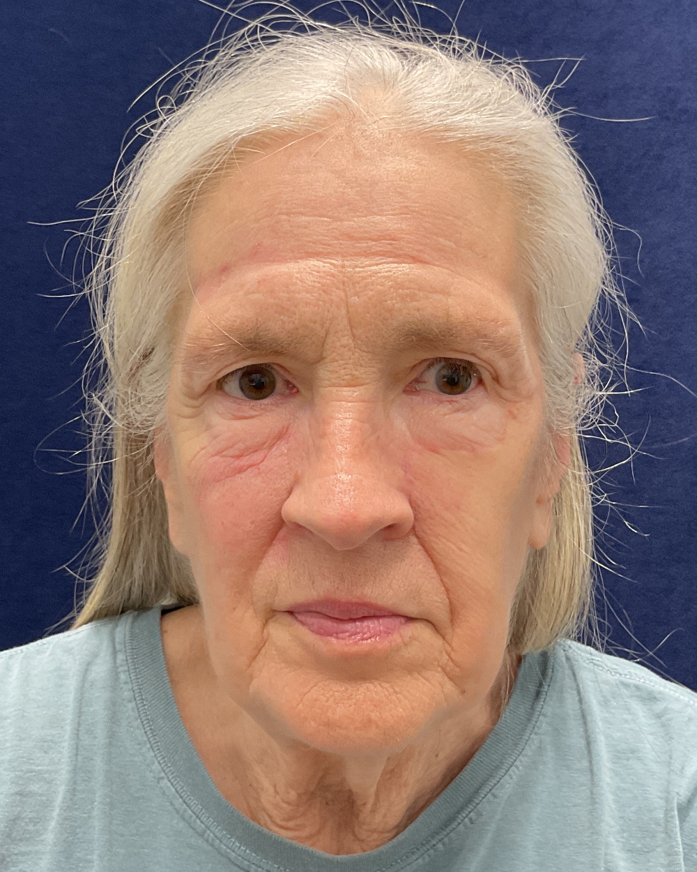 Mohs Reconstruction Patient Photo - Case 5278 - after view