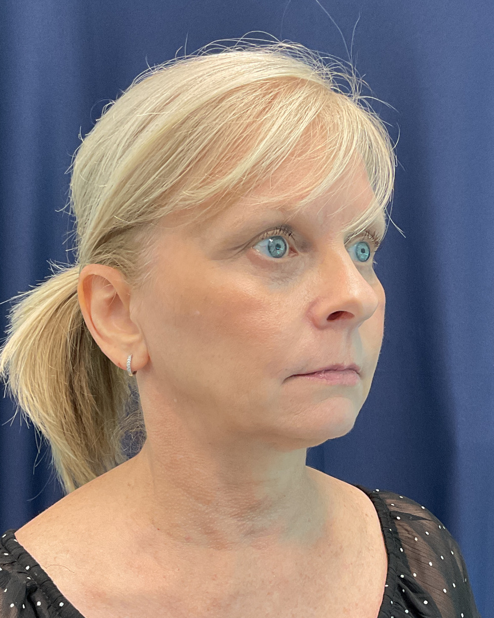 Eyelid Surgery Patient Photo - Case 5366 - before view-2