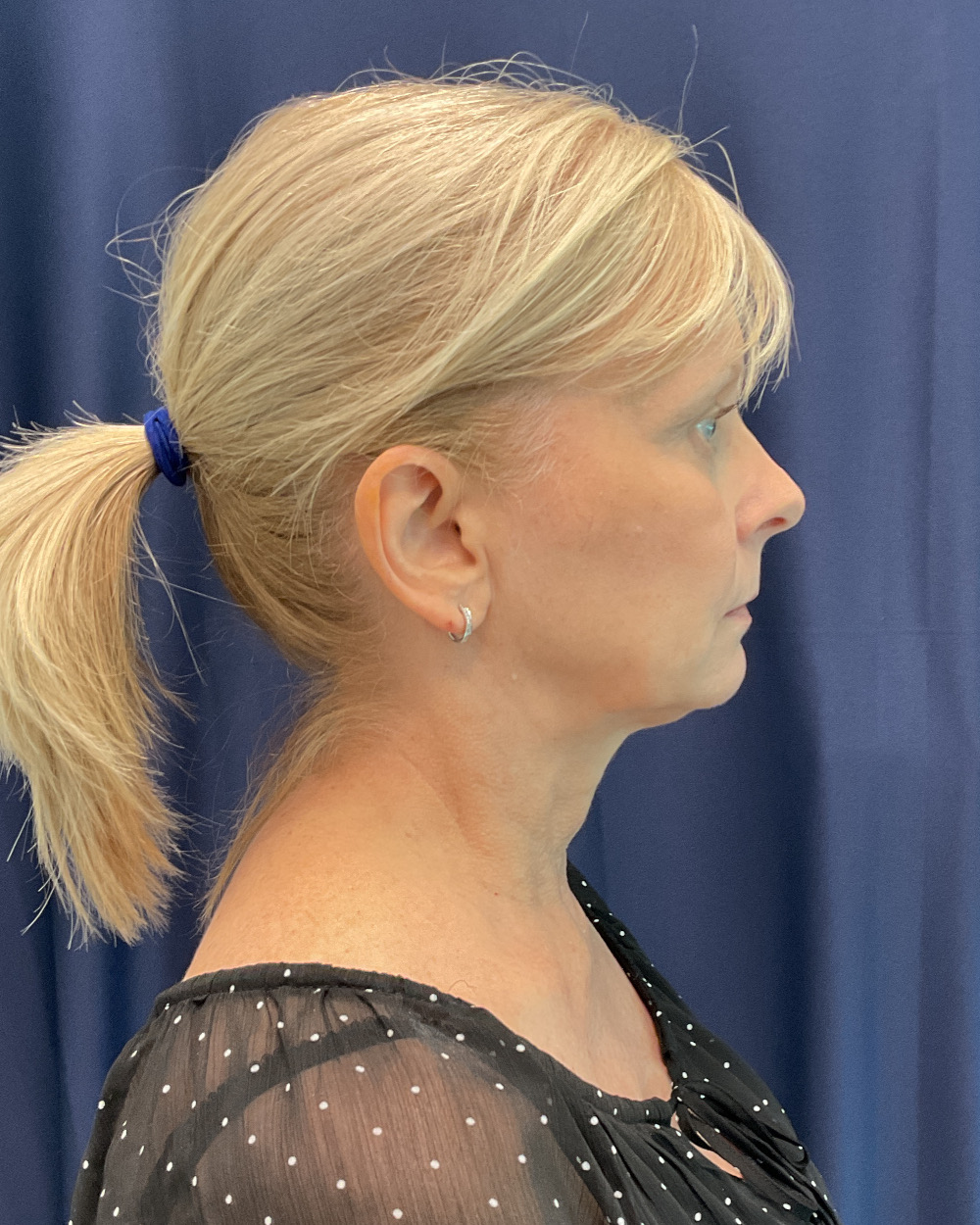 Eyelid Surgery Patient Photo - Case 5366 - before view-3