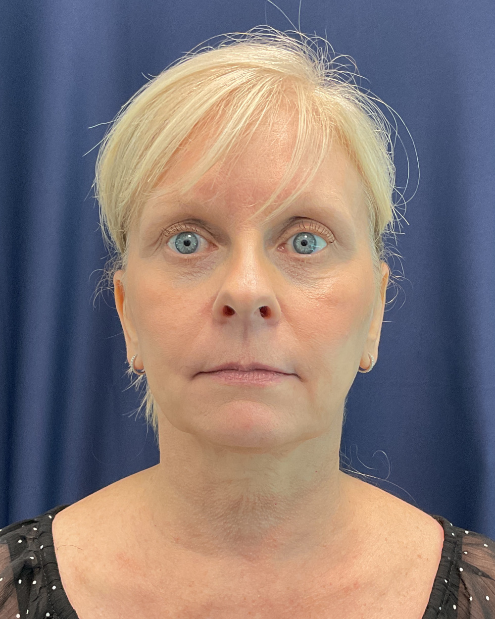 Eyelid Surgery Patient Photo - Case 5366 - before view-