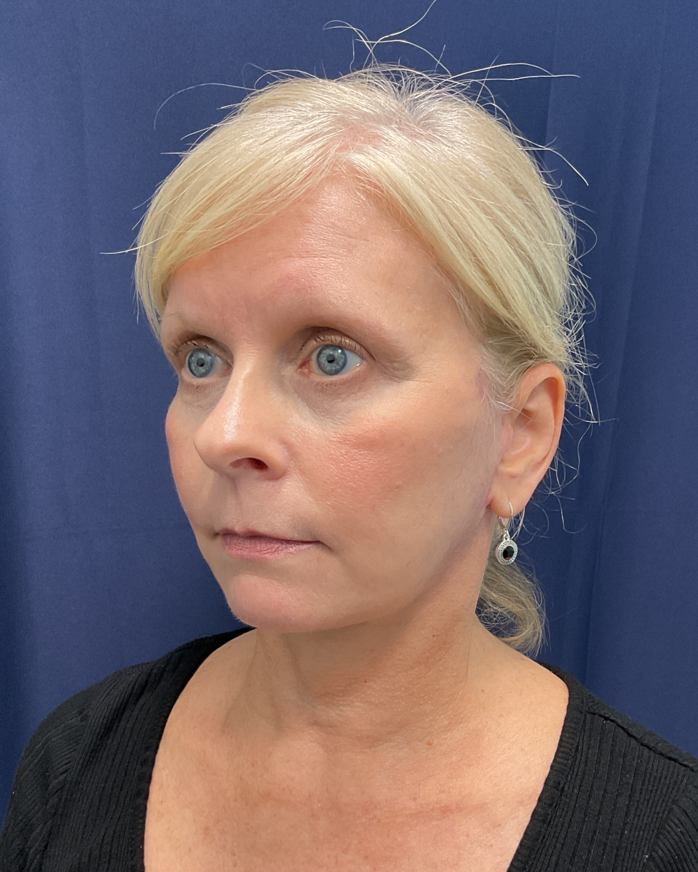 Eyelid Surgery Patient Photo - Case 5366 - after view-1