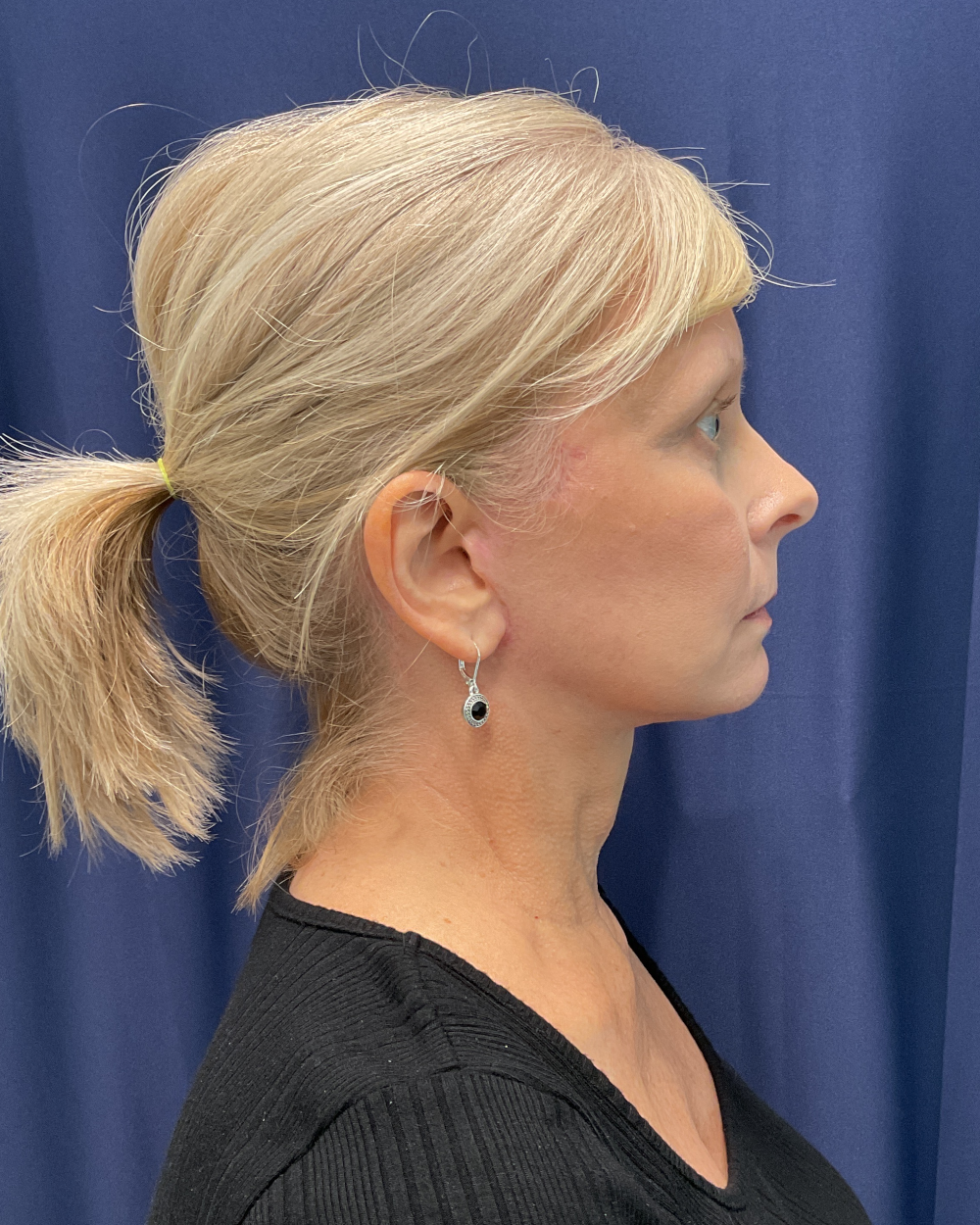 Eyelid Surgery Patient Photo - Case 5366 - after view-3