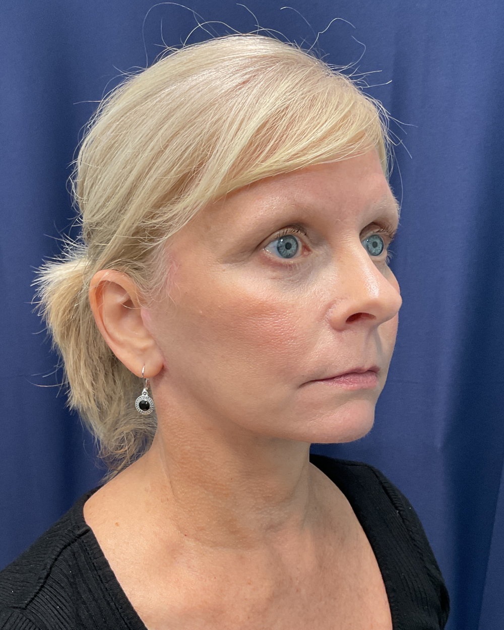 Eyelid Surgery Patient Photo - Case 5366 - after view-2