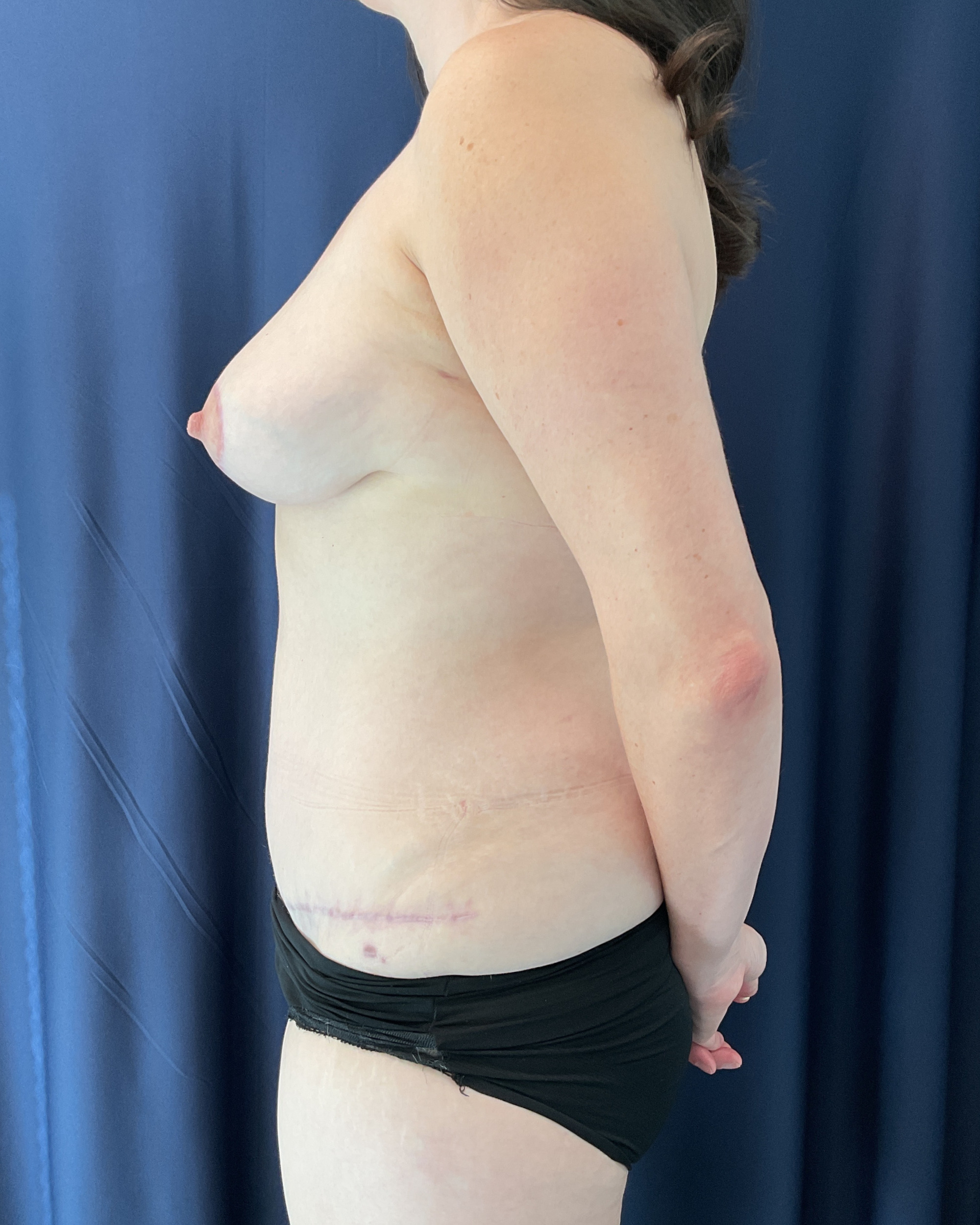 Abdominoplasty Patient Photo - Case 5460 - after view-2