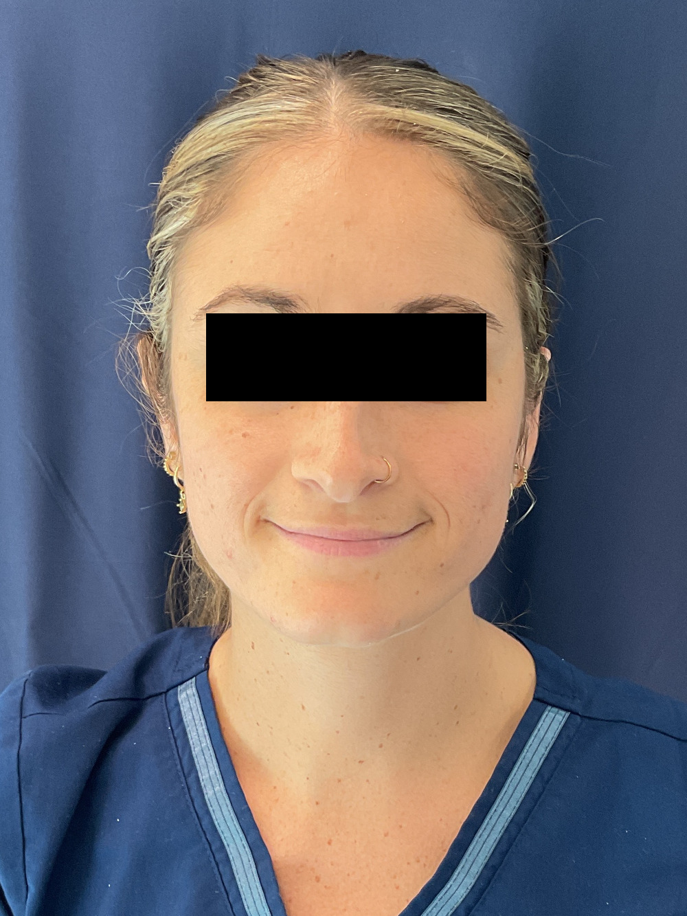 Ear Surgery (Otoplasty) Patient Photo - Case 5509 - after view