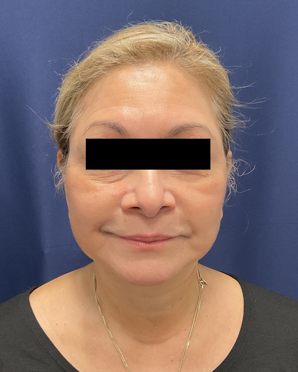 Necklift/Facelift Patient Photo - Case 5529 - after view