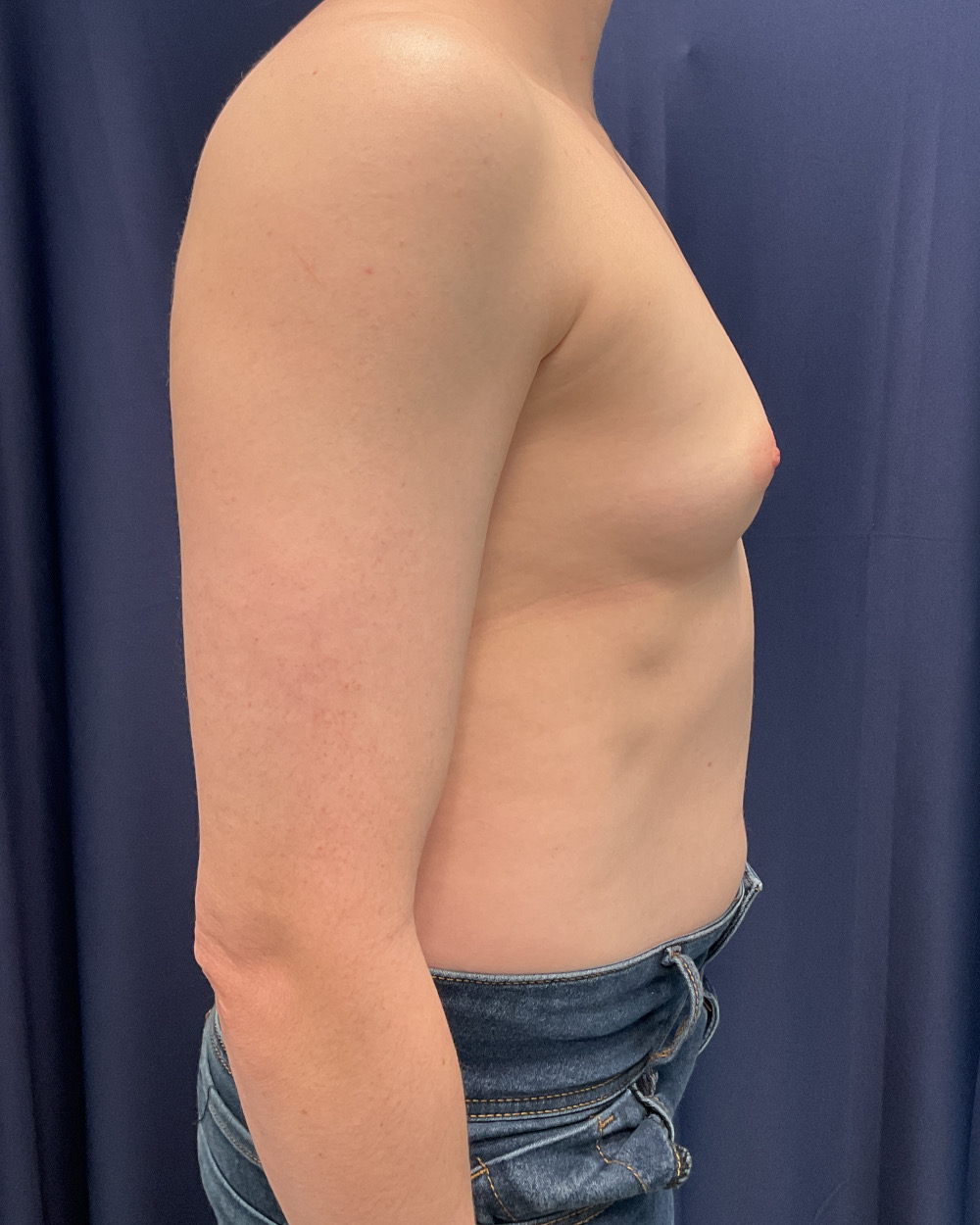 Breast Augmentation Patient Photo - Case 5562 - before view-4